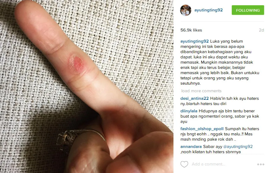 Apakah ini luka karena masak buat Shaheer? ©instagram/ayutingting92