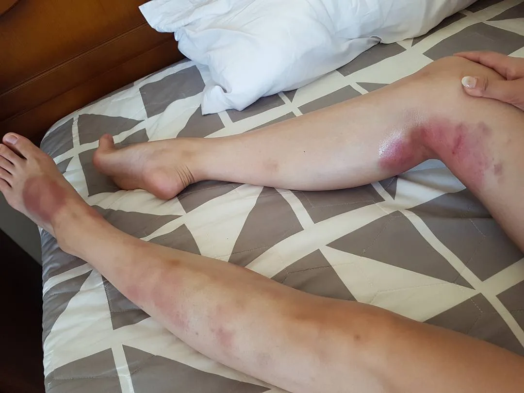 Kondisi kaki Stephanie yang lebam karena latihan pole dance. © koreaboo.com