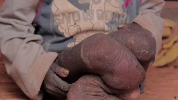 Ramesh lumpuh karena bentuk kakinya yang aneh dan tak bisa bicara. Hal ini menyusahkannya untuk berkomunikasi © viral4real.com