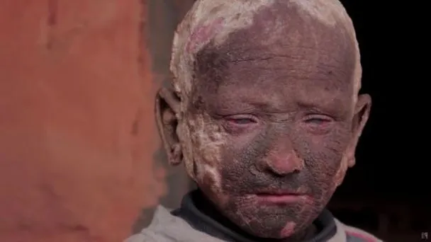 Ramesh, bocah 11 tahun asal Nepal yang mengidap penyakit langka Ichtyosis © viral4real.com