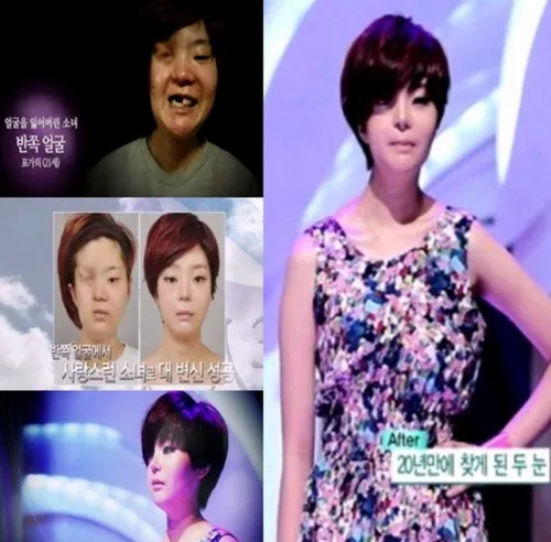 Kerusakan di wajah seseorang bisa diubah sedemikian rupa dengan operasi plastik. ©koreaboo