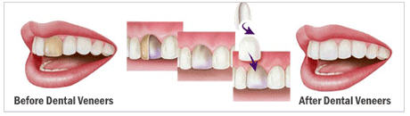 Pemasangan veneer biasanya memerlukan setidaknya 3 kali konsultasi ke dokter gigi © berbagai sumber