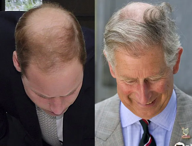 Kepala William botak seperti Pangeran Charles © istimewa