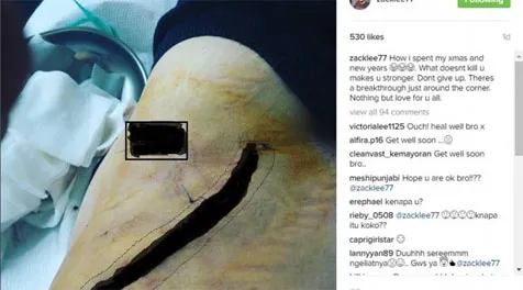 Luka yang didapat Zack Lee dalam kecelakaan motor yang dialaminya © instagram.com/zacklee77