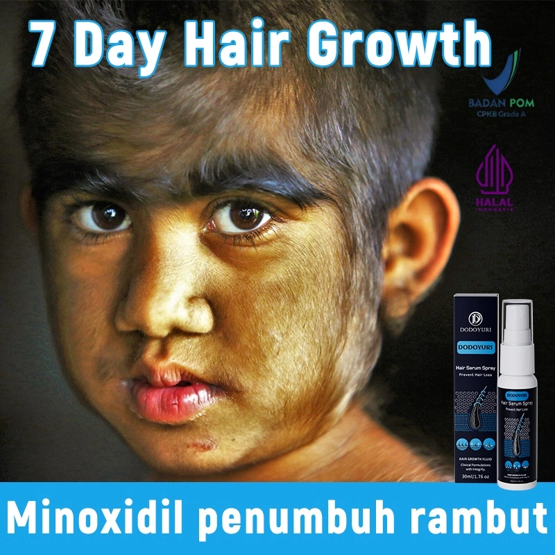 Minoxidil penumbuh rambut serum penumbuh rambut obat rambut rontok serum rambut rontok 30ml penumbuh rambut cepat dan tebal penumbuh rambut botak Kontrol minyak Scalp essence Pertumbuhan rambut Menstabilkan akar rambut Menutrisi secara mendalam