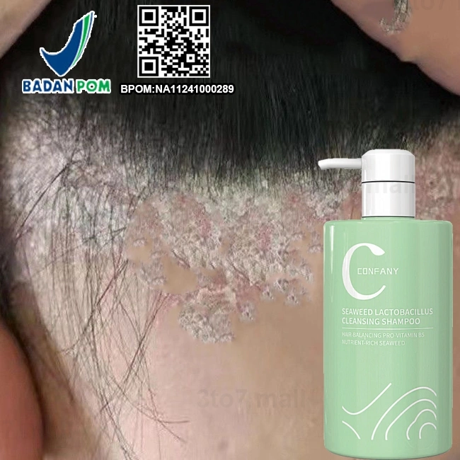 BPOM ketomed shampoo sampo anti gatal and ketombe shampoo psoriasis kepala gatal dan rontok dermatitis seboroik shampoo anti dandruff Oil control