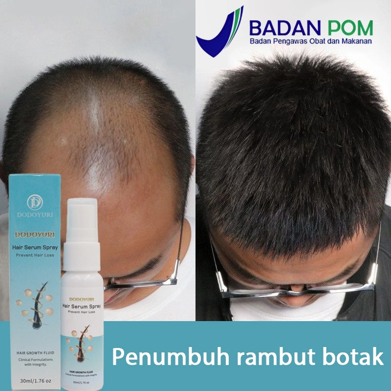 Serum penumbuh rambut hair tonic rambut rontok minyak penumbuh rambut cepat 30ml