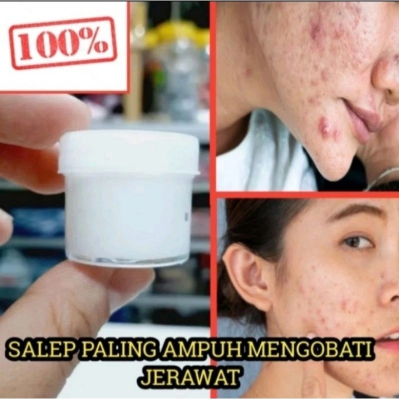 Salep Jerawat Racikan Apotek