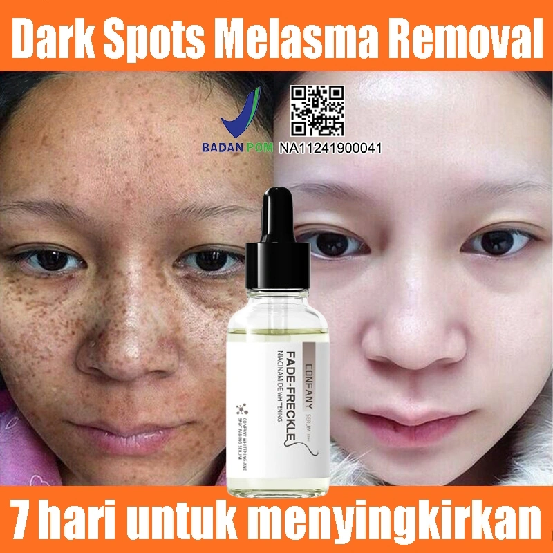 Whitening Freckles Serum 30ml Melasma Mencerahkan Wajah Serum Dark Spot Niacinamide Mencerahkan Kulit Whitening Blemish