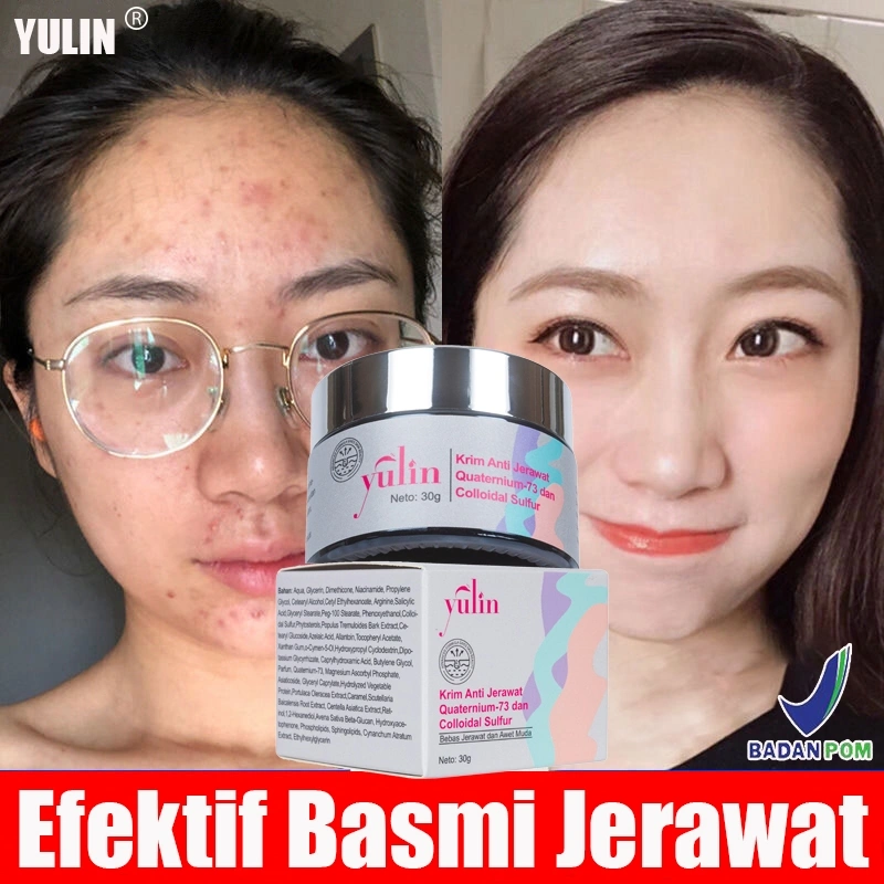 YULIN Acne Spot Cream - Krim Totol Atasi Jerawat - Cream Penghilang Jerawat & Bruntusan | Obat Krim Salep Jerawat | acne jerawat | krim jerawat | obat penghilang jerawat | obat totol jerawat | penghilang jerawat | Krim Anti Jerawat | Acne Care Cream