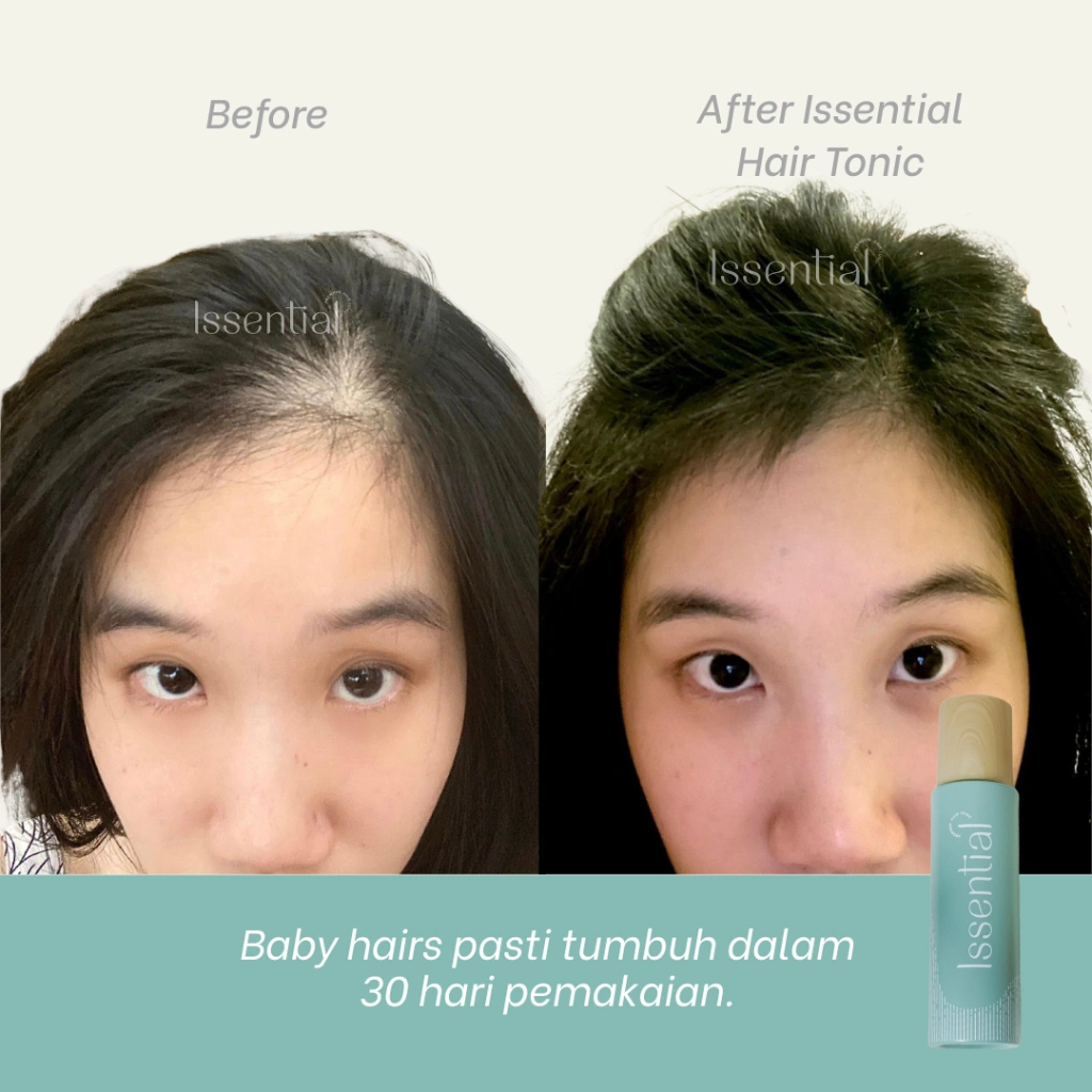 ISSENTIAL Hair Tonic Water Based - Atasi Rambut Rontok Parah & Tipis, Bantu Tumbuhkan Baby Hair Lebih Tebal & Kuat - Tonik Penumbuh Rambut Alami Anti Patah & Bercabang untuk Pria & Wanita - 100ml