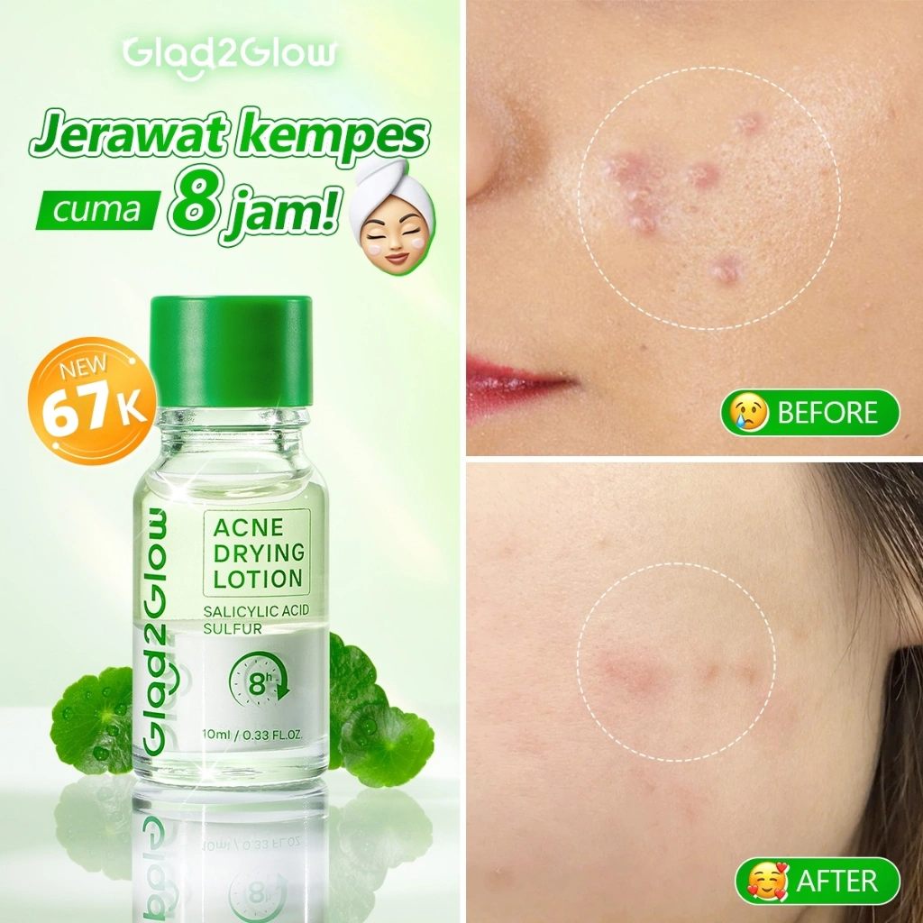 [100% ORI]GLAD2GLOW Acne Drying Lotion - Totol Jerawat Ampuh Malam Hari, Kandungan Aktif: Niacinamide, Zinc Oxide, Salicylic Acid & Sulfur. Membantu Hilangkan Bekas Jerawat & Redakan Kemerahan!