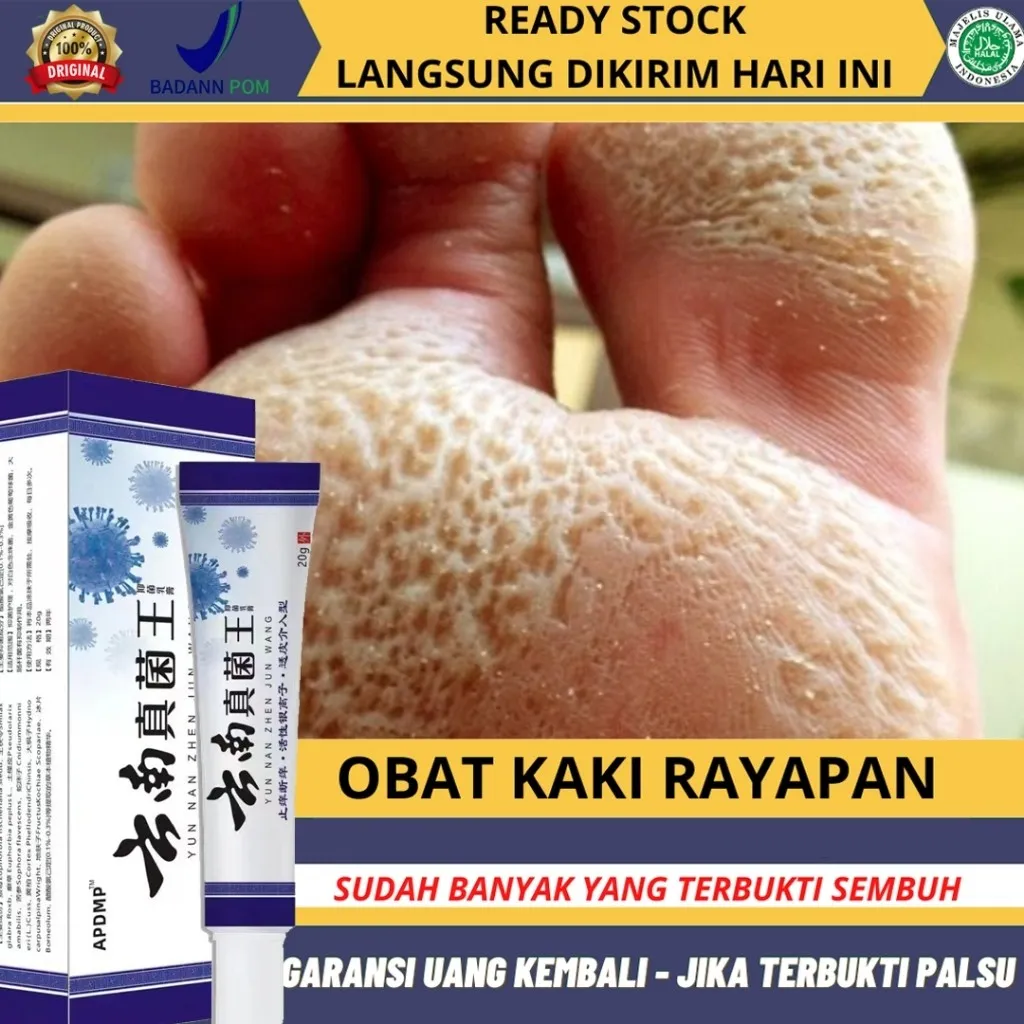 Obat Kaki Rayapan Dan Bau Penghilang Bau Kaki Obat Jamur Kaki Obat Kaki Jamuran Pembersih Kulit Mati Kaki Obat Kaki Bolong Salep Gatal Kaki Paling Ampuh Krim Antibakteri Tinea Pedis