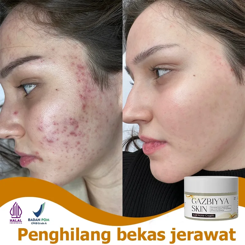 Penghilang jerawat obat jerawat dan bekas jerawat penghilang bekas jerawat 30g Obat jerawat paling ampuh Herbal Essence Menghilangkan Jerawat Memperbaiki Kulit Dengan Cepat Menghilangkan Jerawat Pria dan Wanita