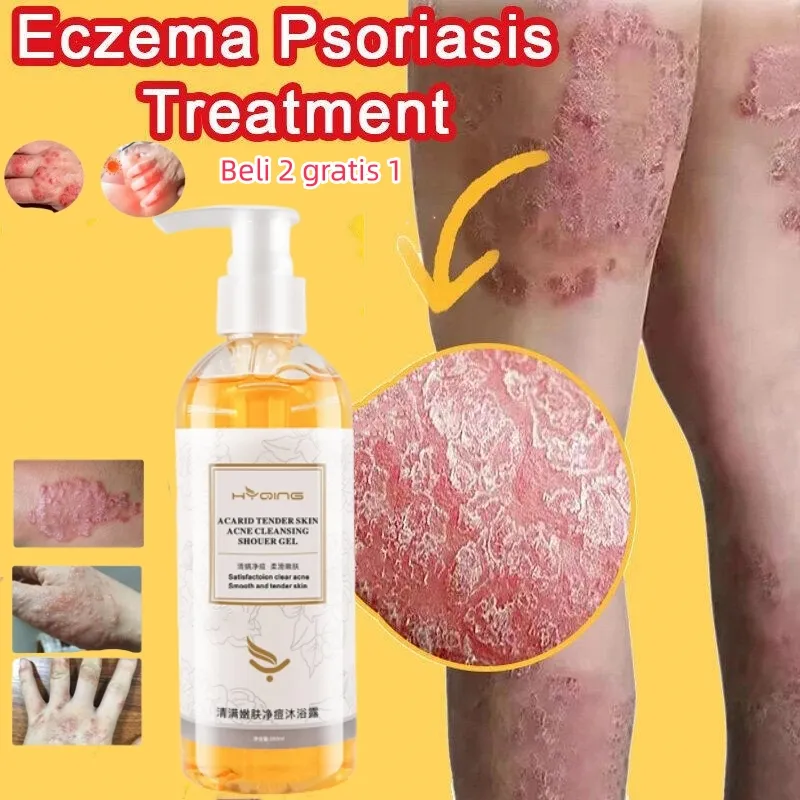 eczema body wash Sabun Gatal Kulit Ampuh psoriasis Eksim Kering Kurap Gatal Sabun Mandi Cair Penghilang Jerawat Menghilangkan Tungau Anti jamur Tinea Cruris
