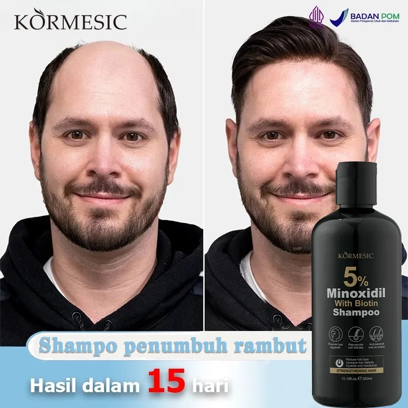 Shampo penumbuh rambut minoxidil 5% Shampo rambut rontok Mencegah rambut rontok Penumbuh rambut cepat Mengontrol minyak dan ketombe Menghilangkan tungau Shampoo 300ml