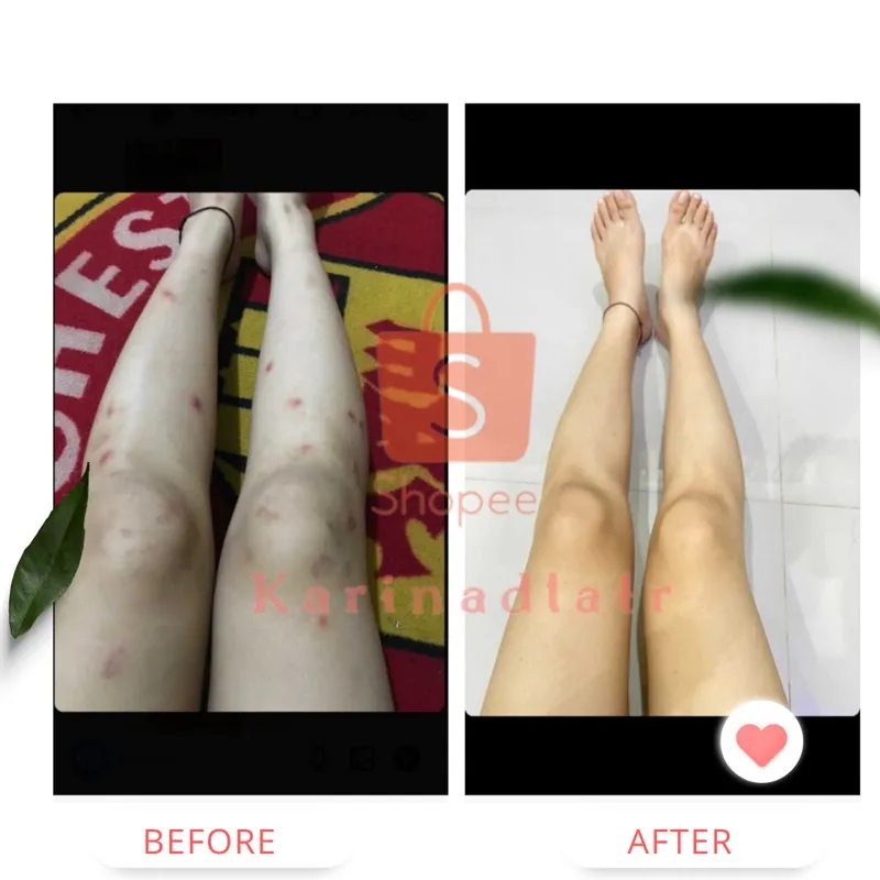 PENGHILANG BEKAS LUKA DAN KELOID SCARS CREAM REMOVEL