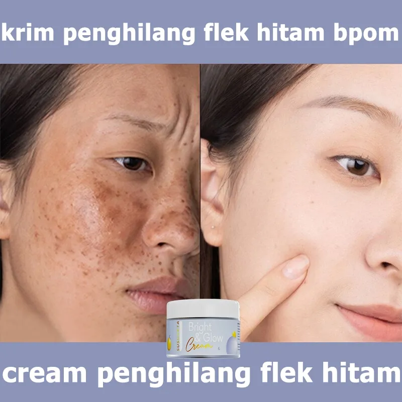 Krim flek hitam ampuh dan cepat krim penghilang flek hitam bpom menghilangkan flek hitam di wajah 30ml cream penghilang flek hitam pemutih wajah cepat 3 hari bpom Perbaikan bekas luka dan bintik bintik secara permanen dan efektif krim pemutih wajah