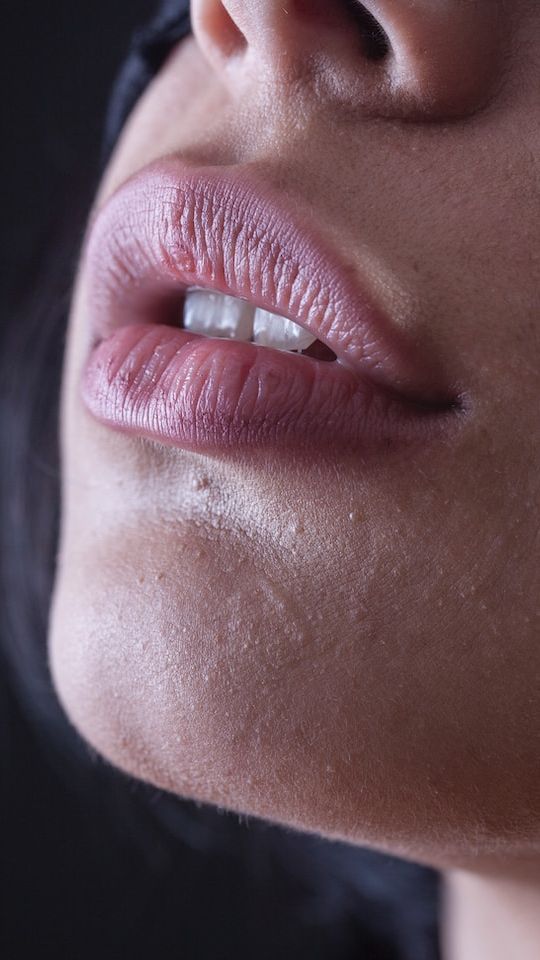 why-are-my-lips-always-dry-and-peeling-10-reasons-and-home-remedies