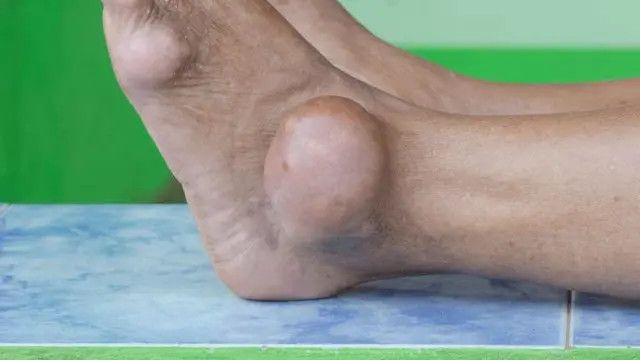 6 Gejala Asam Urat di Kaki, Termasuk Perubahan Warna Kulit hingga Terjadi Pembengkakan