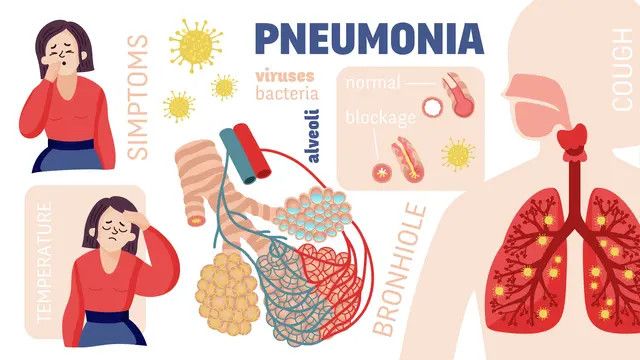 Perbedaan antara Bronkopneumonia dan Pneumonia yang Perlu Kita Ketahui