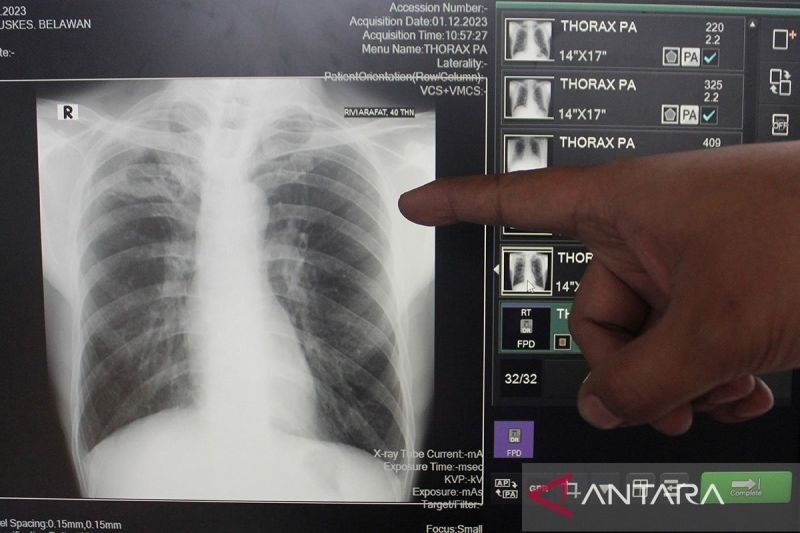 Kemenkes Laporkan 856.420 Kasus TBC di Tahun 2024