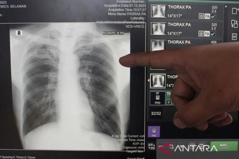Sudinkes Jaktim Perkuat Juru Pemantau Batuk untuk Deteksi Dini TBC