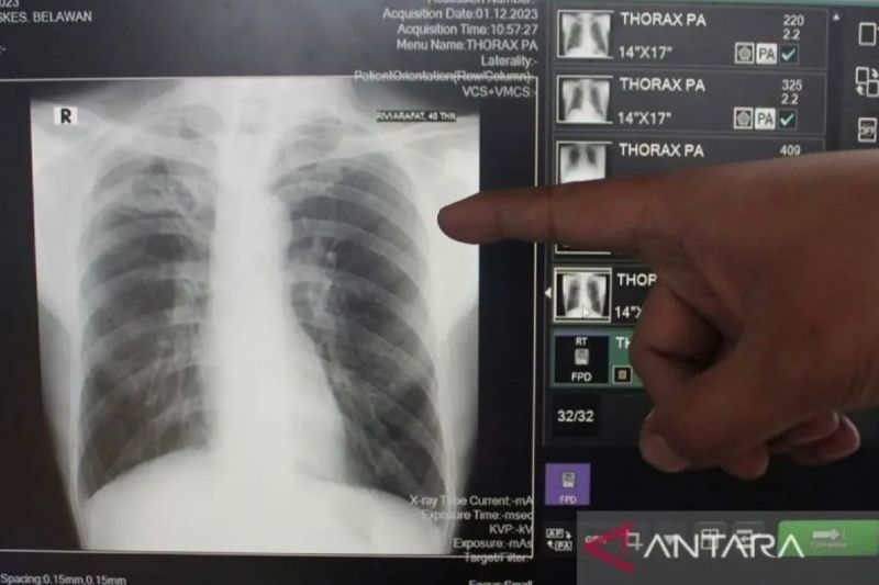 Pemkot Bandarlampung: Kepatuhan Minum Obat, Kunci Sembuh dari TBC