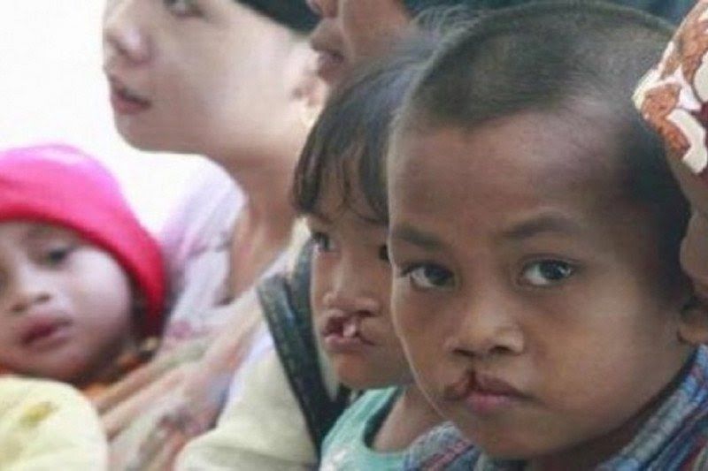 Bibir Sumbing dan Celah Langit: Gangguan Perkembangan yang Perlu Perhatian Serius