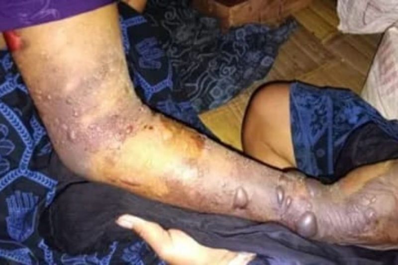 Tujuh Warga Badui Meninggal Akibat Gigitan Ular Berbisa: Keterlambatan Penanganan Jadi Sorotan