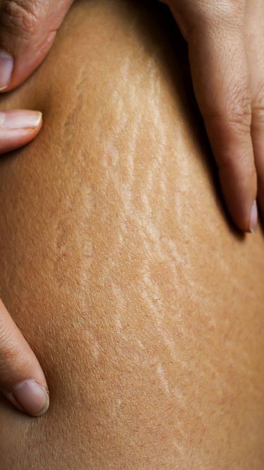 Sering Jadi Kekhawatiran Banyak Orang, Stretch Marks Ternyata Bisa Disamarkan dengan Perawatan Dalam Lho