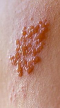 Waspadai Penyebab Penyakit Herpes Kulit, Bisa Menular Melalui Kontak Kulit