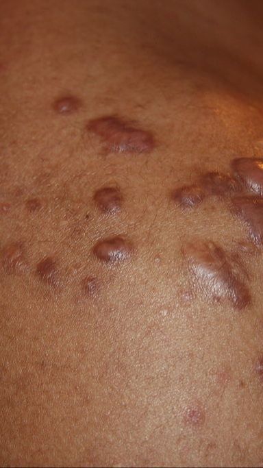 9 Cara Mudah dan Sederhana Obati Keloid di Rumah secara Mandiri