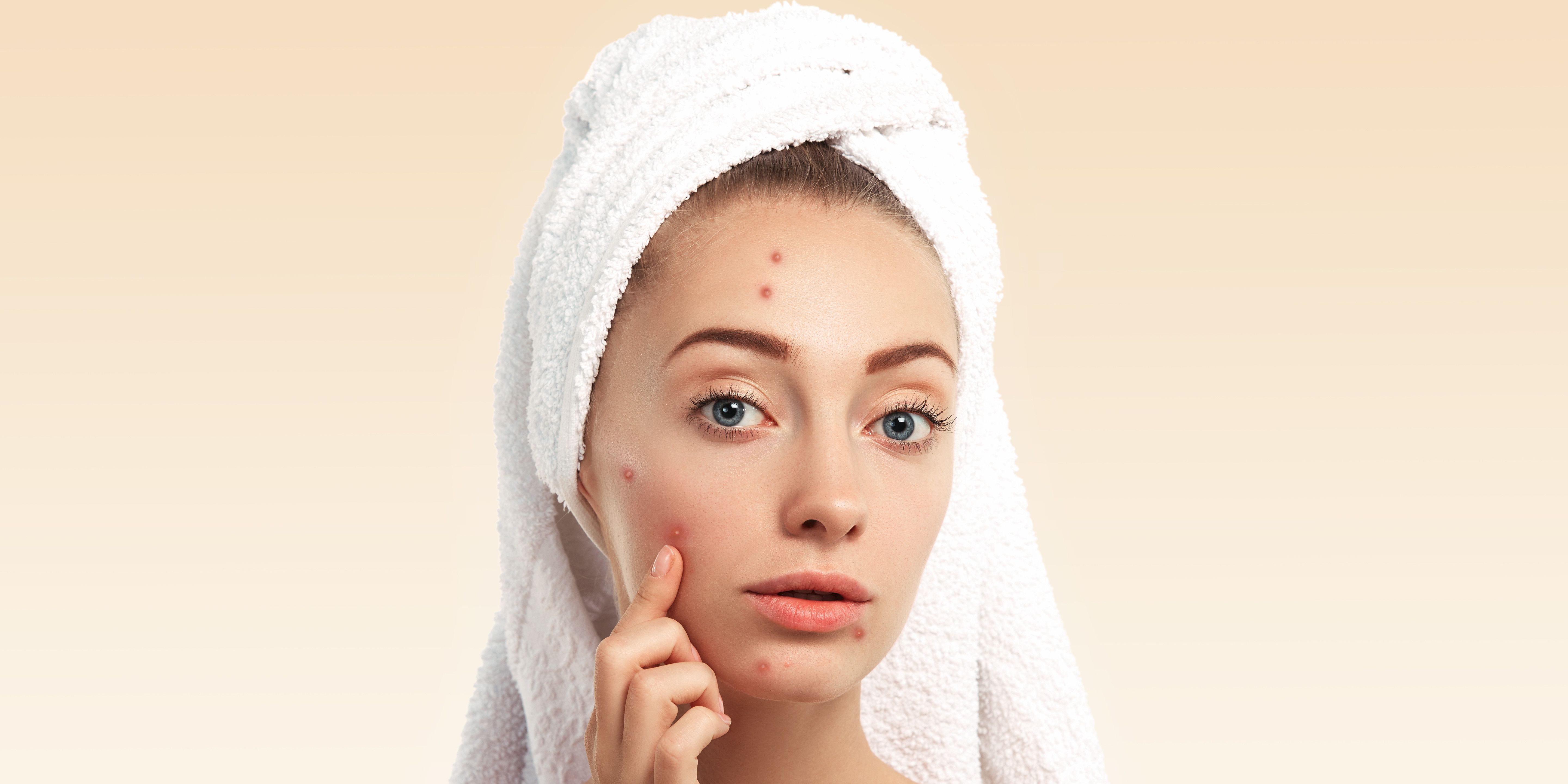 Jerawat Hilang Tanpa Skincare? Ini 9 Cara Alami yang Bisa Dicoba