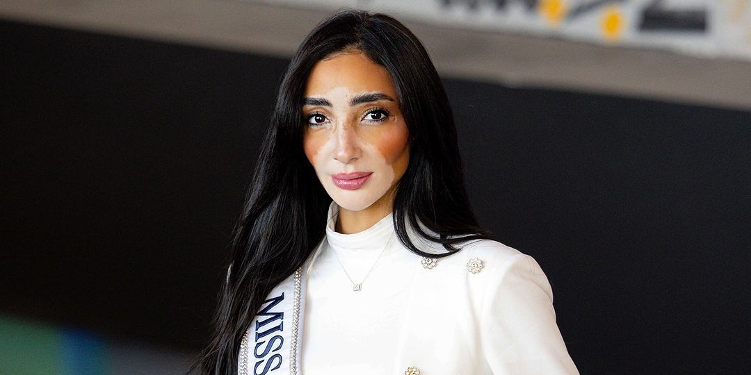 Intip Profil Menarik Logina Salah, Peserta Miss Universe Pertama yang Mengidap Vitiligo