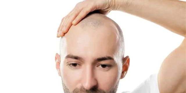 12 Cara Mencegah Rambut Menipis dan Menjadi Botak