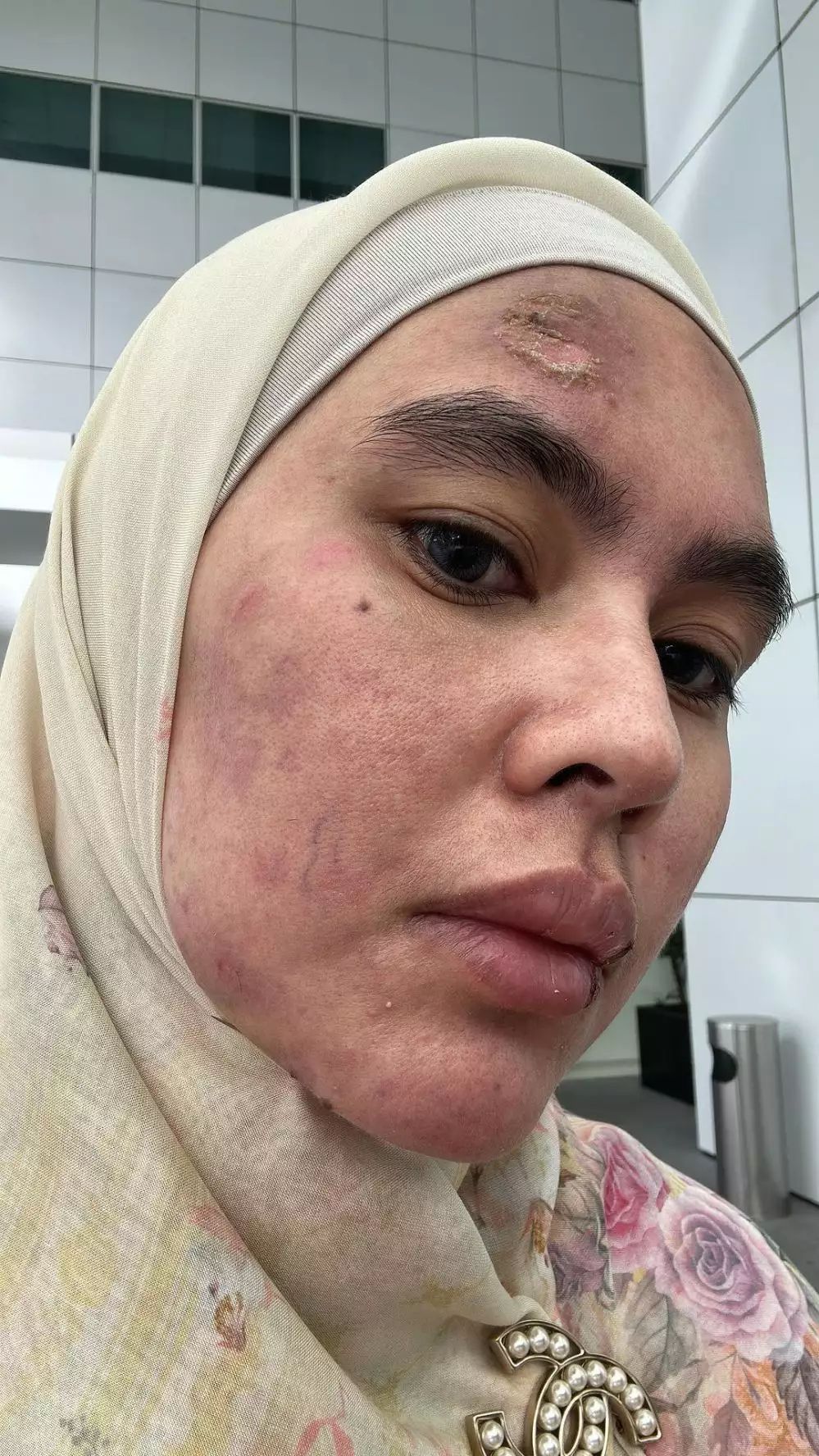 Muka Sempat Melepuh Potret Terkini Wajah Kartika Putri Yang Manglingin