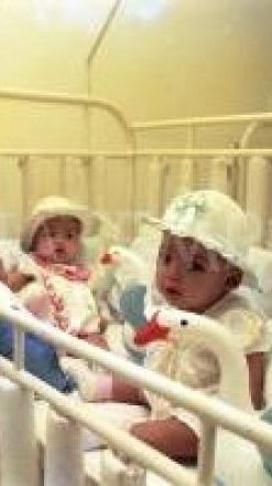 Still Remember the Siamese Twins Yuliana-Yuliani? Once Viral, Now a ...