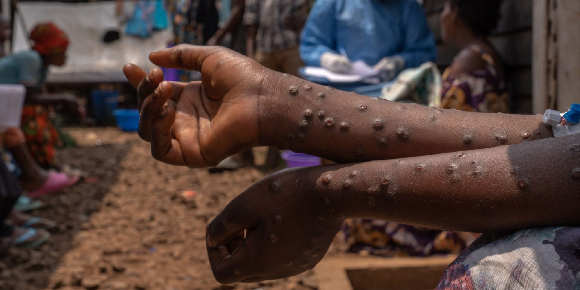 Pasien Mpox Bisa Isolasi Mandiri di Rumah, Ini Syaratnya