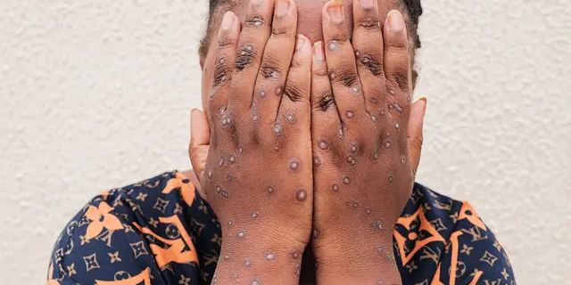 8 Senjata Rahasia yang Bisa Dilakukan untuk Menghentikan Penyebaran Mpox