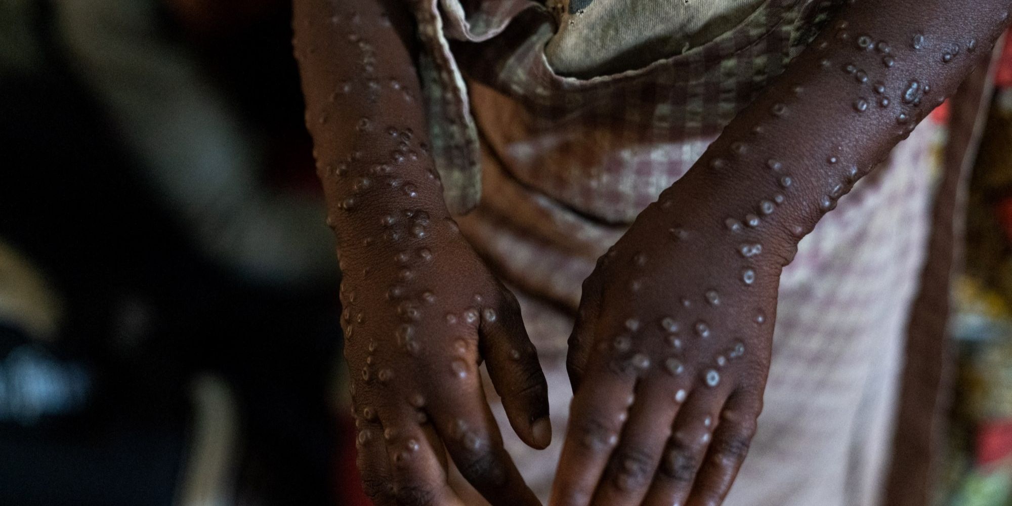 CEK FAKTA: Hoaks Virus Mpox Disebabkan karena Efek Samping Vaksin Covid-19