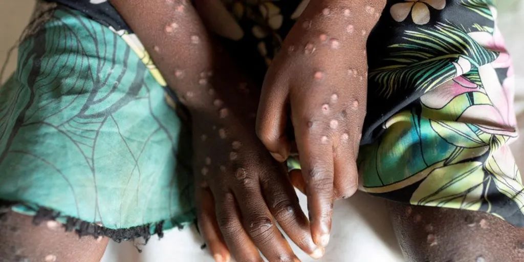 Hasil Tes Lab Keluar, Pasien Suspek Mpox di Bali Ternyata Negatif