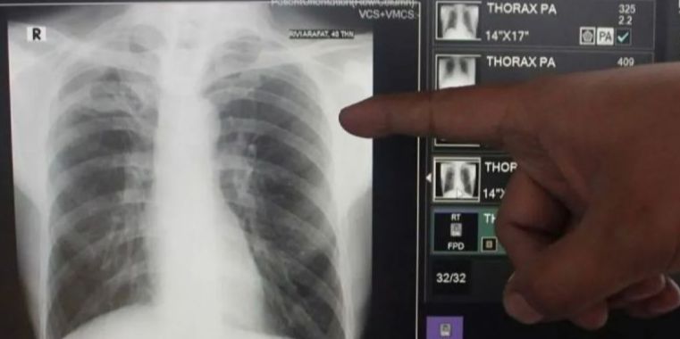 Banyak Pasien Tak Tahan Minum Obat Terus, Menkes Bakal Sederhanakan Pengobatan TBC dari 6 Bulan jadi 90 Hari