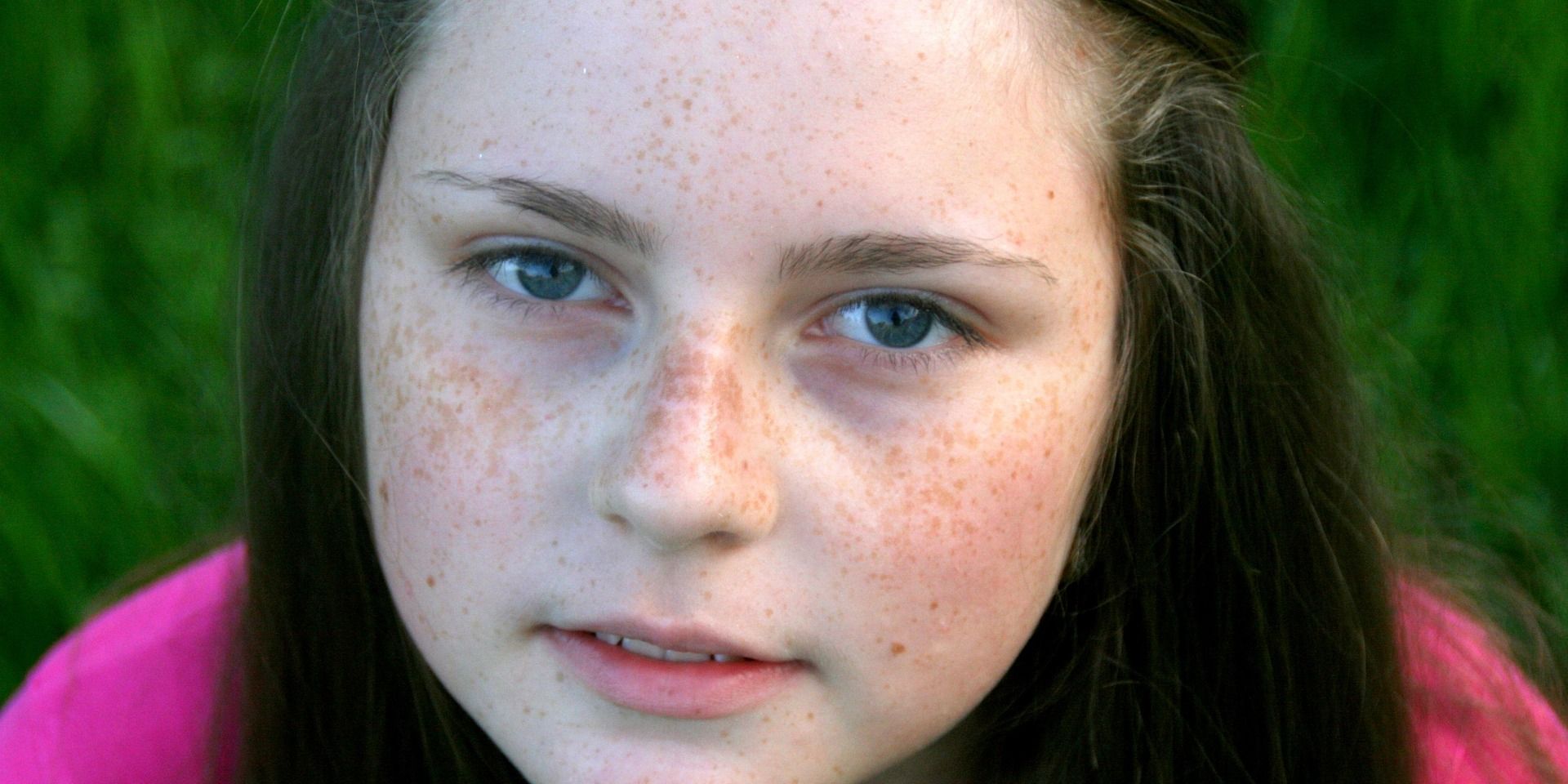 Waspadai Freckles di Wajah: Simbol Kecantikan atau Sinyal Masalah Kesehatan? Ini Penjelasan Medisnya