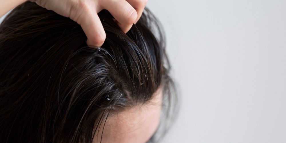 Solusi Praktis untuk Rambut Berminyak dan Lepek