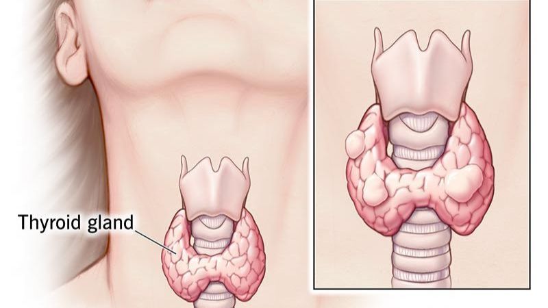 9 Makanan yang Dianjurkan untuk Penderita Hipertiroid, Perlu Diketahui