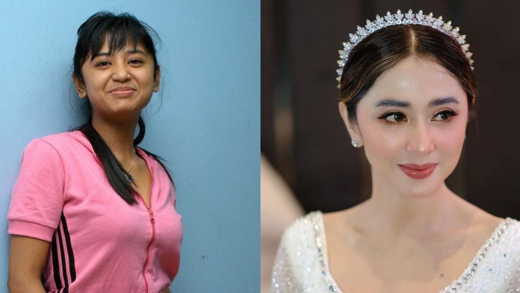 Deretan Artis Lakukan Tanam Benang, Ini Foto Before-Afternya