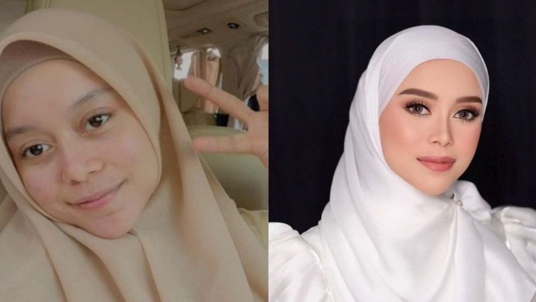 13 Transformasi Artis yang Melakukan Perawatan Dagu Runcing, Sebelum dan Sesudahnya Mengejutkan