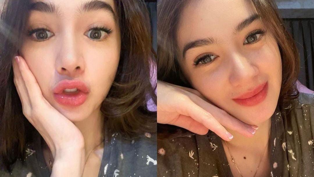 Akhirnya Terungkap! Potret Wajah Angel Karamoy Usai Oplas di Korea, Cantiknya Dipuji Natural Gak Lebay