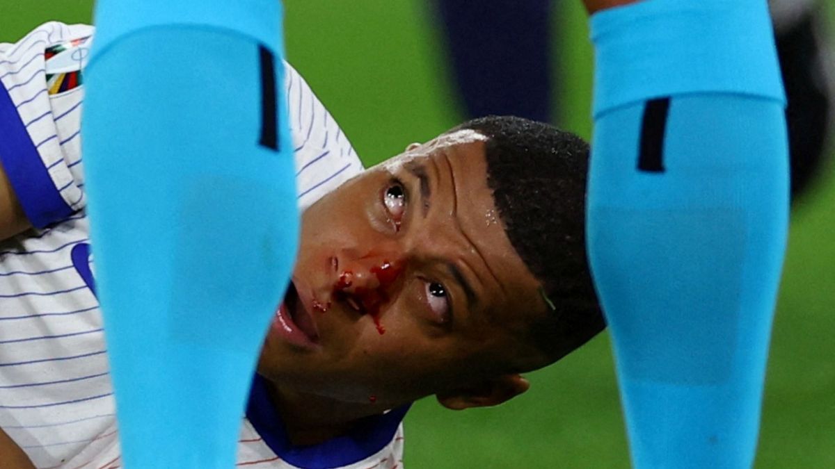 FOTO: Momen Hidung Kylian Mbappe Patah dan Berdarah Saat Laga Prancis Vs Austria